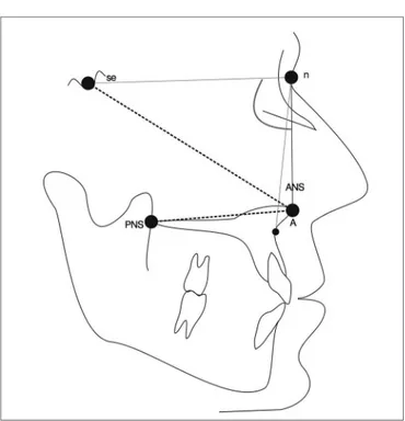 Figure 2. Cephalometric parameters used for facial analysis. S: Sella  turcica; n: Nasion; ANS: Anterior nasal spine; PNS: Posterior nasal  spine; A: Most concave point of the maxilla 23 .