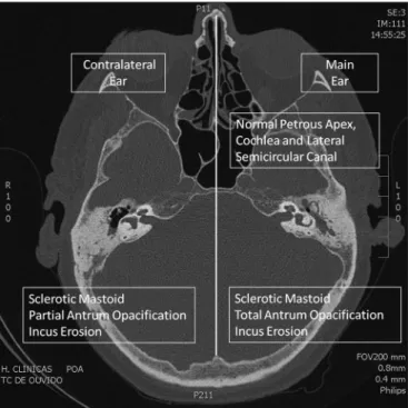 Figure 1.  Axial CT Scan. Comparison of abnormalities in the main (left)  and contralateral (right) ear.