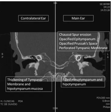 Figure 2.  Coronal CT Scan. Comparison of abnormalities in the main  (left) and contralateral (right) ear.