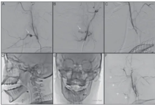 Figure 1. A and B: Left external carotid angiography (lateral  and AP projections) showing a pseudoaneuryms of the  linguo-facial trunk (arrows); C: Final control after internal trapping; 