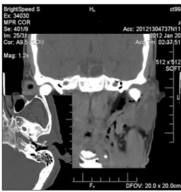 Figure 1. Coronal and axial CT images. External auditory canal  anterior wall fracture and consequent emphysema of the ipsilateral  parapharyngeal space.