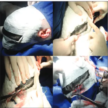 Figure 3. Example of how the contralateral electrode is transposed  via the orotracheal tube.