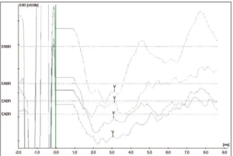 Figure 10.  Digisonic SP ®  Binaural cochlear implant. Receiver-stimulator  and ipsilateral and contralateral electrode beams.