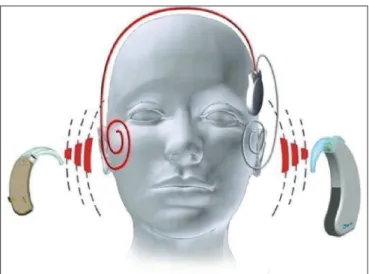 Table 1. Preoperative pure-tone audiometry.