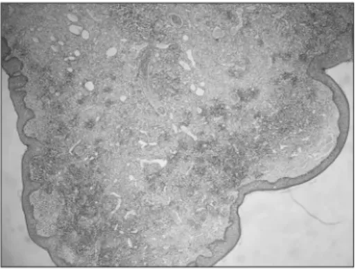 Figure 1. The three components of tonsillar lymphangiomatous  polyps: dilated lymphatic channels, ibrous stroma, and lymphoid  tissue (100x).