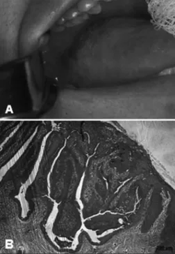 Figure 1. A: Irregular tumor located in the right lateral border of  the tongue. B: Endophytic tumor with papilliferous squamous  epithelium surface; the base of the tumor presents a transition from  squamous epithelium to ductal columnar epithelium.