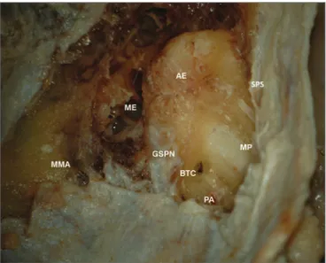 Figure 1. Anatomy of the middle cranial fossa. ME: Middle ear; AE: 