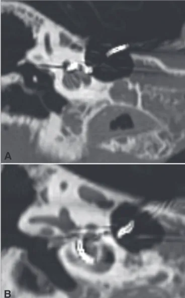 Figure 3. A-B: Right temporal bone high-resolution CT scan. Coronal  view, bone window, showing the placement of the array from the basal  (A) to the apical (B) turn of the cochlea.