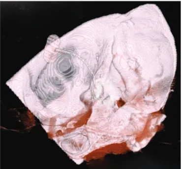 Figure 5. Right temporal bone high-resolution CT scan. 3D  reconstruction showing the placement of the CI array through  the middle cranial fossa.