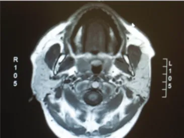 Figure 3. Axial section in T1 with contrast and fat suppression, showing  hyposignal in the areas in which fat was suppressed.