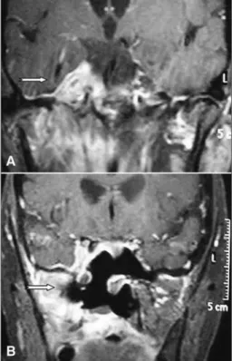 Figura 1. A: Ressonância magnética de crânio (T1 com con- con-traste) pré-operatório. A seta aponta lesão expansiva em seio  cavernoso direito; B: Ressonância magnética de crânio (T1 com  contraste) pós-operatório