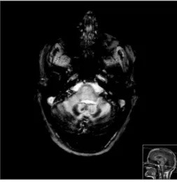 Figure 1. MRI - CE, axial slices in T2*, where we see intense hypo  signal in T2* of the pial coating of all the structures in the posterior  fossa, in the internal vertent of the occipital lobe and the Sylvian  issures,  marked  cerebellar  atrophy,  tran