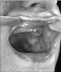 Figura 1. Oroscopia: Lesões ulceradas e bolhosas em mucosa  jugal e palato.