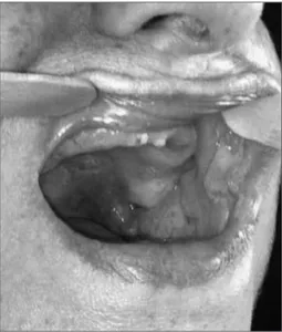 Figure 1. Oroscopy - Bullous and ulcerated lesions on the cheek  mucosa and palate.