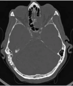 Figure 1. Axial view CT scan: soft-tissue density tumor in left  posterior ethmoidal cells measuring 19 x 20 x 30 mm.