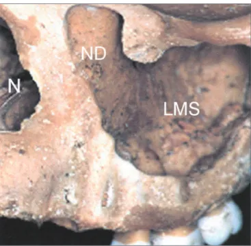 Figure 1. Anterolateral view of the medium portion of the face in  a bony anatomical specimen