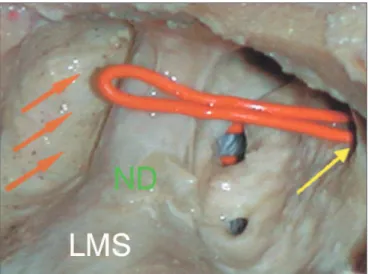 Figure 2. Lateral view of the dissection of the left maxillary sinus of  the ANT (anterior) type
