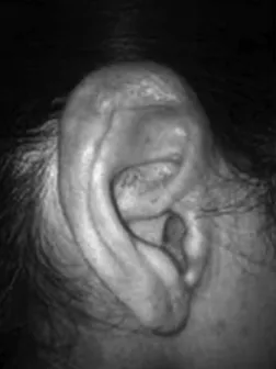 Figure 1. Amyloidosis lesion on the ear pinna.