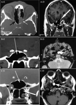 Figure 1. A: (Left) axial CT scan of sinuses shows complete opa- opa-ciication of the left sphenoid sinus with dehiscence in the left optic  canal (white arrow), opticocarotid recess (black arrow); (Right) MRI  shows the cyst with rim enhancement obstructi