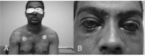 Figure 1. A: Cyanosis of the upper third of the chest extending  to the neck and head