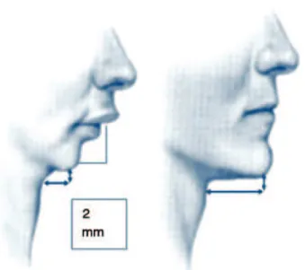 Figure 1 Retrognathia.