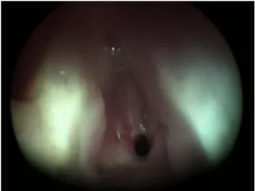 Figure 2 Chronic subglottic stenosis. Child with chronic grade III SGS, pre-dilatation.
