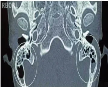 Figura 1  Tomograia computadorizada de mastoide em corte  transversal. No interior dos círculos claros, visualiza-se  velamento parcial bilateral de células mastoideas.