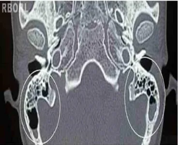 Figure 1 Mastoid computed tomography, cross-sectional view. Within the clear circles, a bilateral partial clouding of mastoid cells is observed.