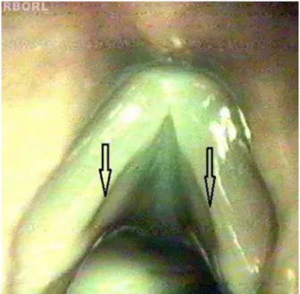 Figure 2 Longitudinal depression, similar to the sulcus vocalis (arrows) observed at the surgical microscope at 40 times  mag-nification.