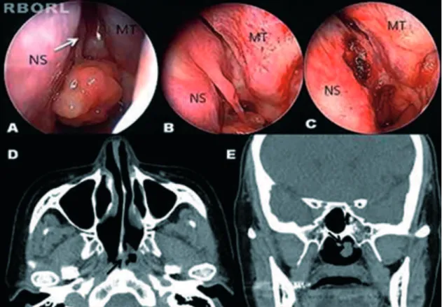 Figura 1  Visualização endoscópica e achados de TC dos SPN. A, Incidência em close up do pólipo nasal com base no septo posterior  esquerdo (Seta branca, pedículo; NS, septo nasal; MT, concha média)