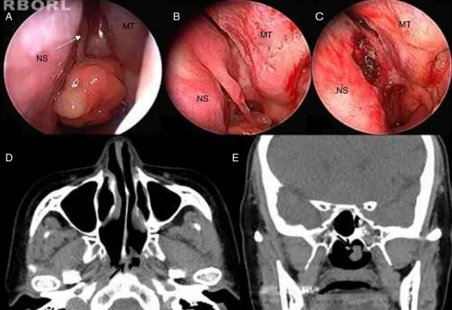 Figure 1 Endoscopic view and PNS CT findings. (A) Close-up view of the nasal polyp based in the left posterior septum (whitish arrow, pedicle; NS, nasal septum, MT, middle turbinate)