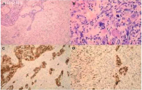 Figura 1  O tumor apresentava dois componentes malignos diferentes, carcinoma (esquerda) e sarcoma (direita) (A, ×100, HE)