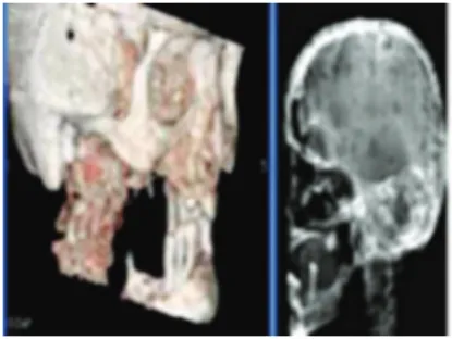 Figure 1 a, 3D Ct illustrating gross mandibular destruction over  the right ramus region