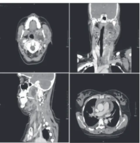 Figure 1 Computed tomography showing large abscess affec- affec-ting multiple cervical spaces and extending into the anterior mediastinum.