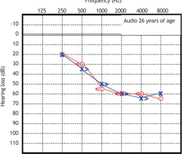 Figure 5 Audiometry in patient 2, performed at 11 years of  age.-100102030405060708090100110-100 10 20 30 40 50 60 70 80 90 100 110 -1001020304050 60 70 80 90 100 110-100102030405060708090100110125  250  500  1000 2000  4000  8000125  250  500  1000 2000  