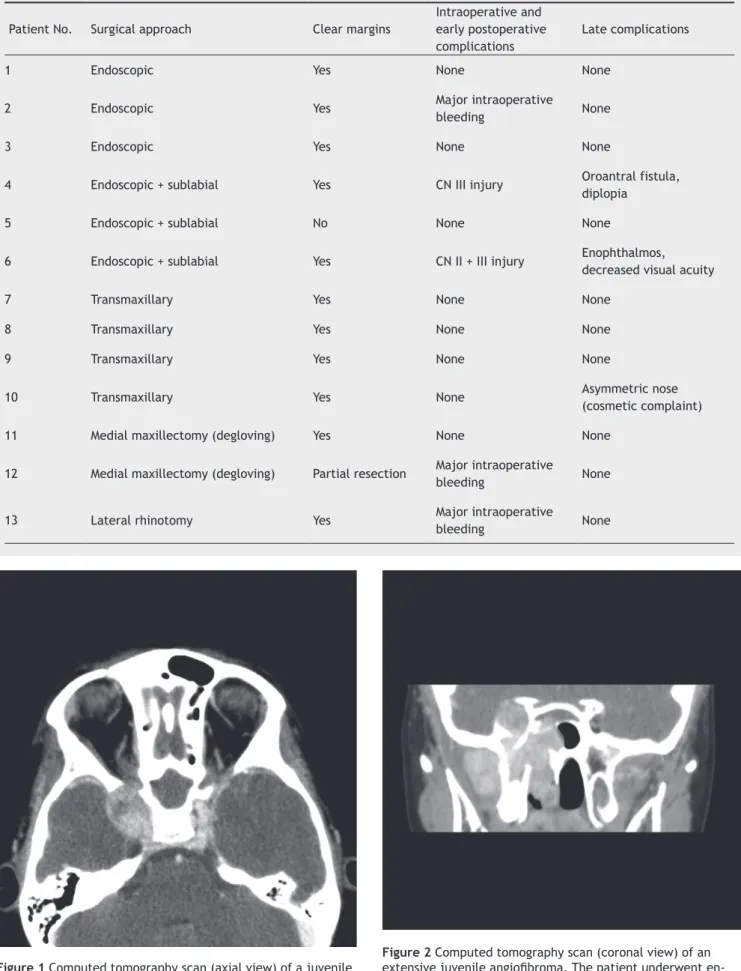 Figure 1 Computed tomography scan (axial view) of a juvenile  angioibroma extending into the right cavernous sinus.