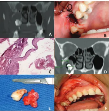 Figure 1 A, Coronal view of computed tomography showing the  obstruction of the right maxillary sinus by a lesion of cystic  aspect associated with a molar tooth