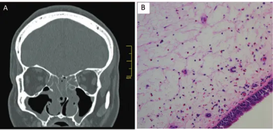 Figure 1 A, Computed tomography of the paranasal sinuses. Coronal section showing the polyps occupying the nasal cavities bila- bila-terally, with opaciication of the ethmoid sinuses due to retention of secretion and insertion of antrochoanal polyps in the