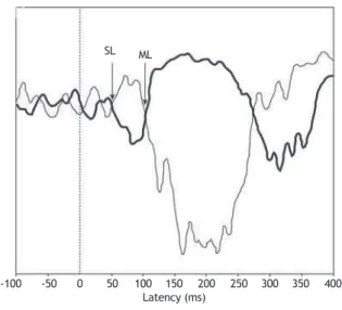 Figure 2 Signals recorded in the right soleus muscle. The thin  trace indicates the response from the anode positioned on the  right mastoid, and the thick line the response from the anode  positioned on the left mastoid
