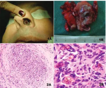 Figure 1 Clinical image of the septal lesion (1A). Lesion  removed with mucosal segment (1B)