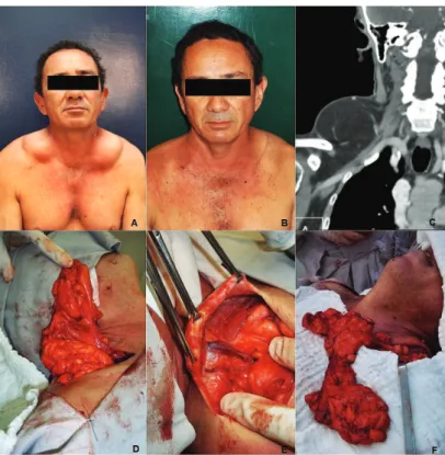 Figure 1 A, preoperative period; B, postoperative period; C, cervical computed tomography; D, intraoperative period, right side;  