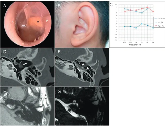 Figure 1 (A) Otoscopic examination reveals streak-like structure (asterisk) behind the eardrum