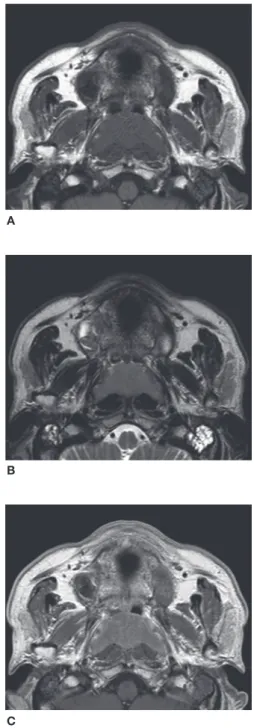 Figura 2  Imagens de ressonância magnética (RM) do tumor  nasofaríngeo. Massa nasofaríngea bilateral revela baixa  intensi-dade de sinal em imagem ponderada em T1 (T1WI) (A) e sinal  de intensidade intermediária em T2WI (B)