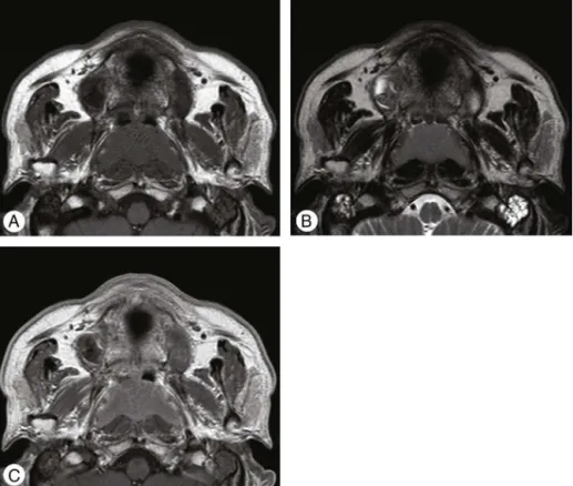 Figure 2 Magnetic resonance (MR) images of nasopharyngeal mass. Bilateral nasopharyngeal mass reveals low signal intensity on T1-weighted image (T1WI) (A) and intermediate signal intensity on T2WI (B)