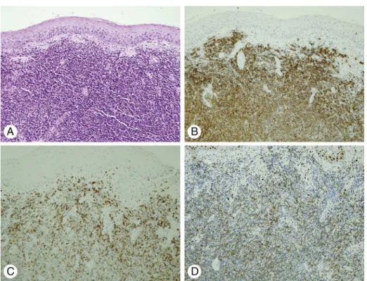 Figure 3 Histopathologic findings of nasopharyngeal mass. (A) Microscopic finding shows diffuse infiltration of small lymphocytic cells with mild nuclear atypia (H&amp;E, ×200)