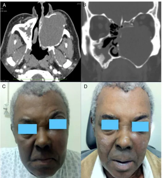 Figure 1 (A) Computed tomography (CT) (axial section), showing an expansive lesion occupying the entire left maxillary sinus and promoting remodeling of bone limits