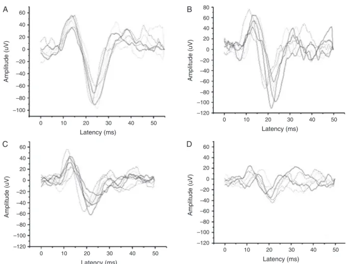 Figure 1 Records of vestibular evoked myogenic potential wave tracings by tone-burst stimuli frequency.