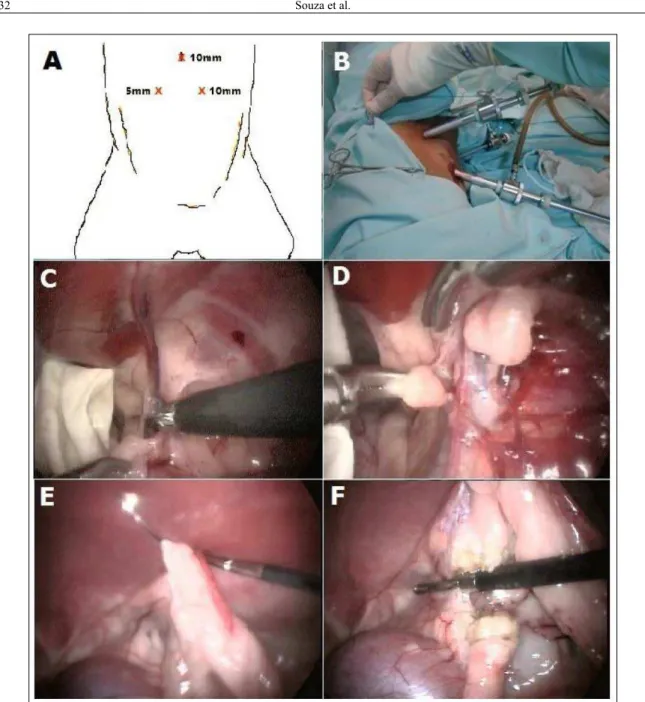 Figure 1 - Laparoscopic inguinoiliac lymphadenectomy and  ovariohysterectomy in dogs. In “A”, disposition of the  three trocars to perform the laparoscopic lymphadenectomy with the animal in dorsal recumbency