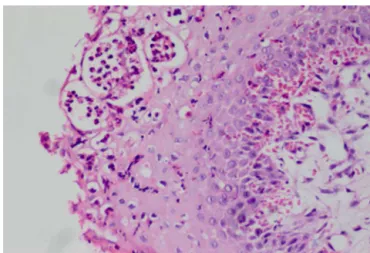 Figure 3 A, B, C, D groups relationship between the severity of inflammation. 0, no inflammation; 1, mild; 2, moderate; 3, severe.