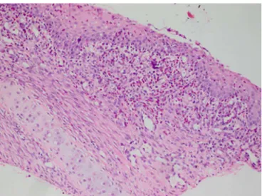 Figure 4 Severe acute inflammation of the submucosa (H---E 200 × ).